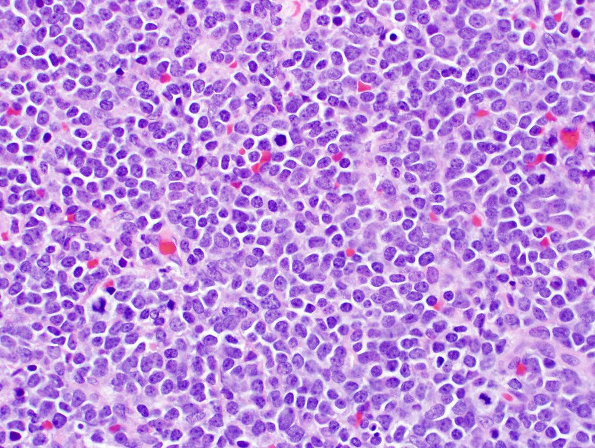 Higher power of lymph node containing sheets of mononuclear cells